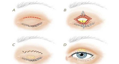 Blepharoplasty