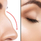nose plastic surgery